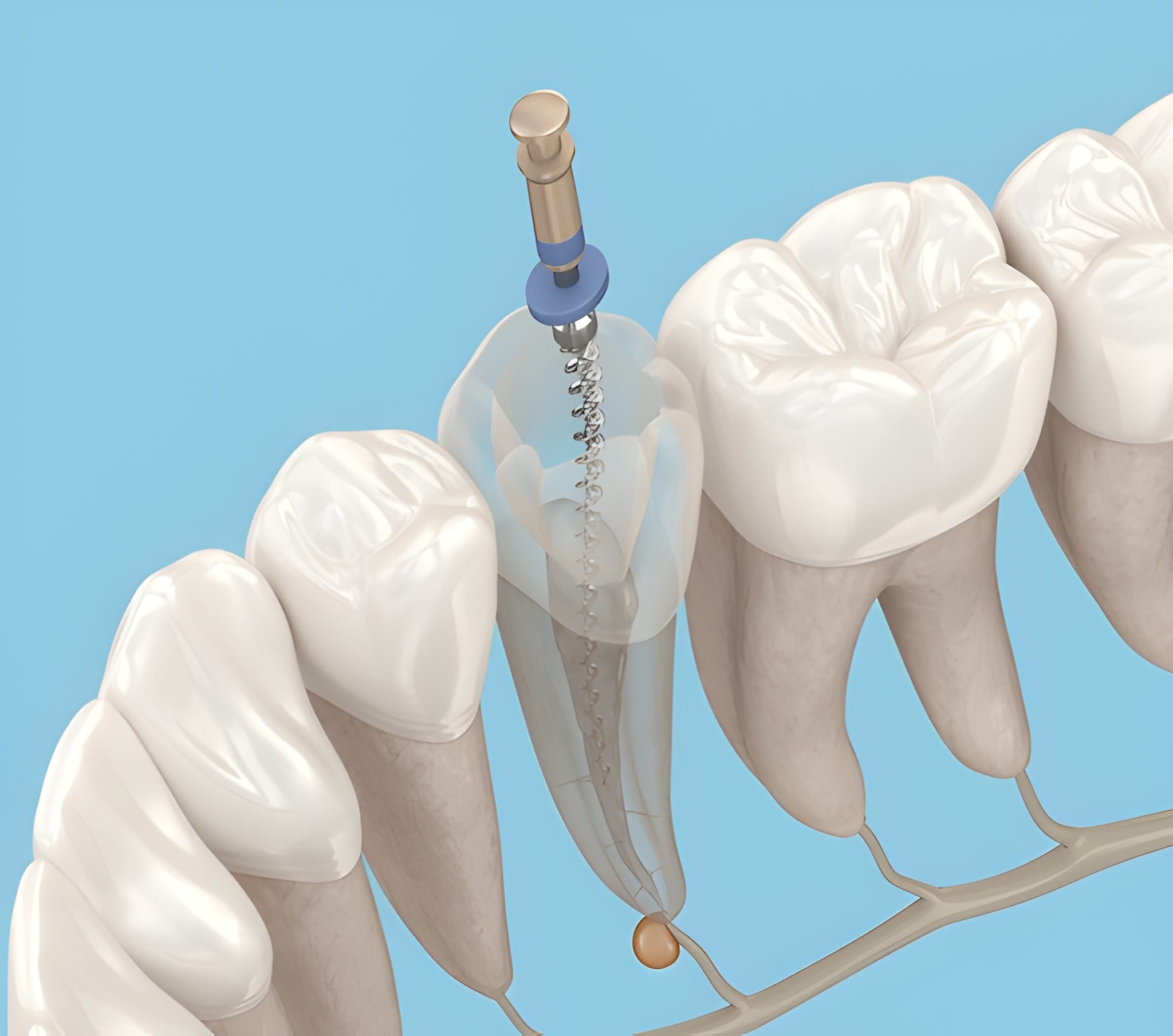 Dental illustration of common causes of tooth infection
