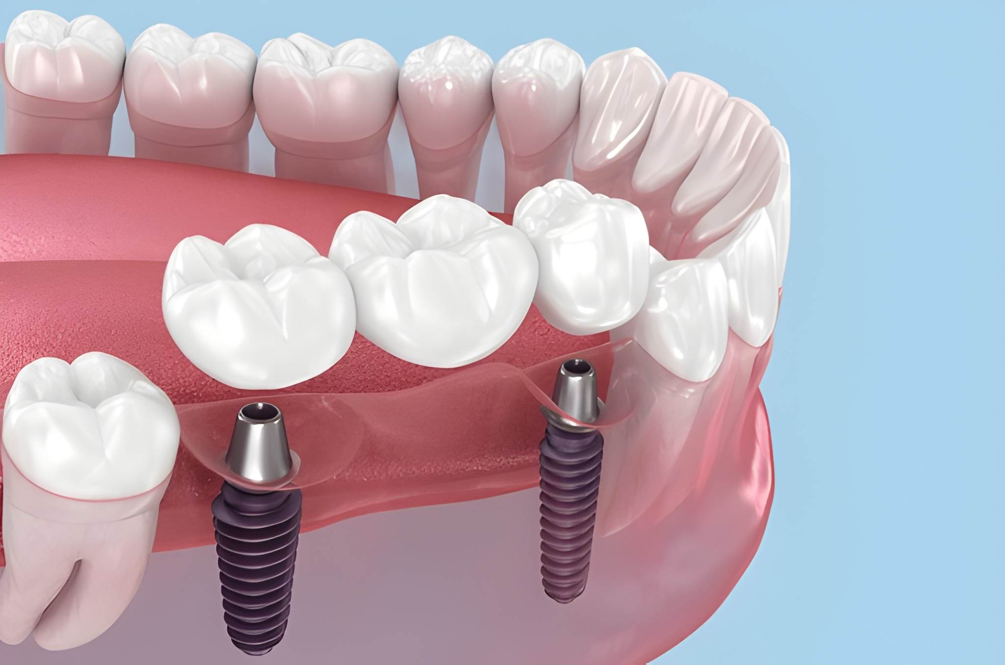 dental bridges near you