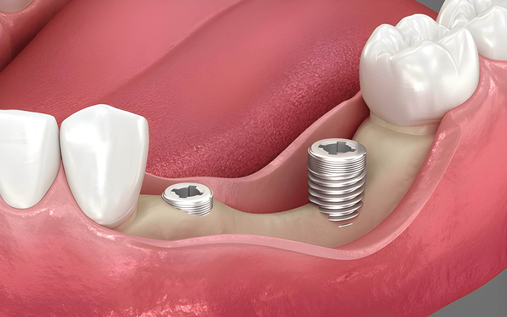 dental implants in midtown toronto