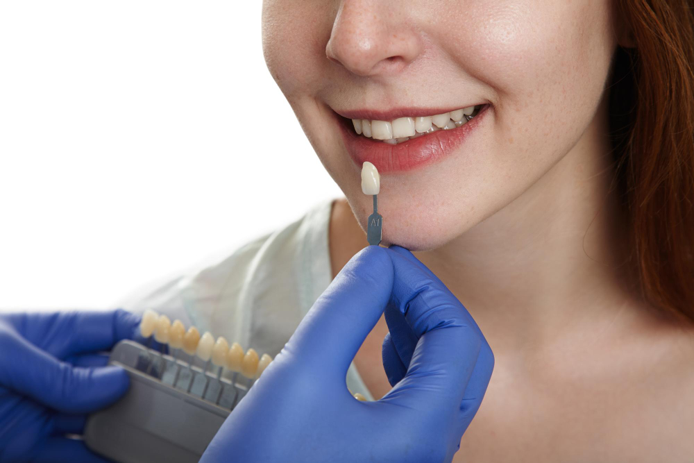 dental veneers near me