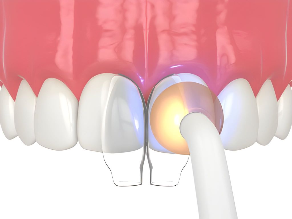 Dental bonding in Midtown Toronto